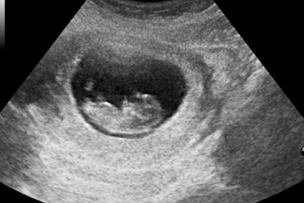 AO Scan vs Ultrasound